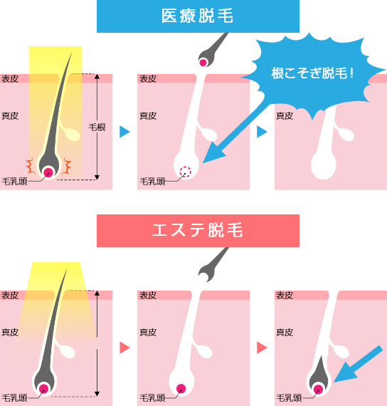 医療脱毛